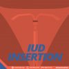 IUD INSERTION 1