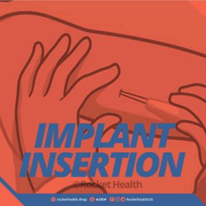 Implant-Insertion-+-Device-(Gynaecologist)