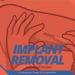 Implant-Removal-(Gynaecologist)