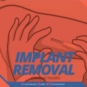 Implant-Removal-(Gynaecologist)