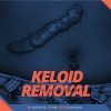Small-Keloid-Removal